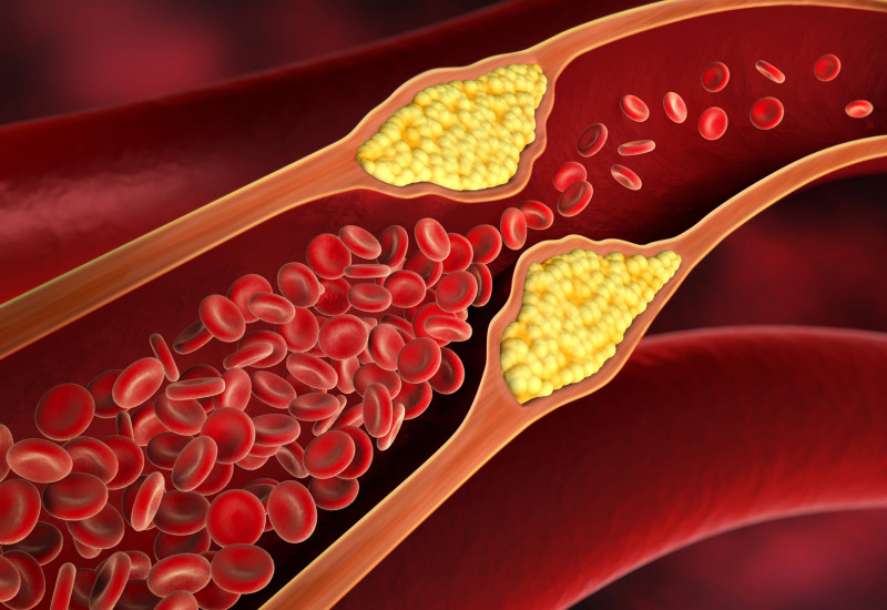 Arteriosclerosi: arterie ostruite dal grasso la causa 
