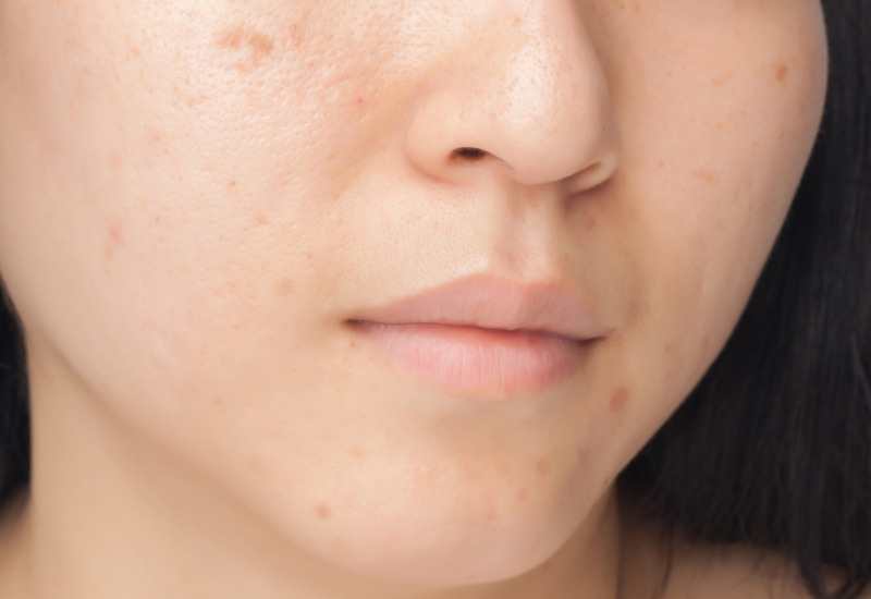 Come eliminare le cicatrici da acne