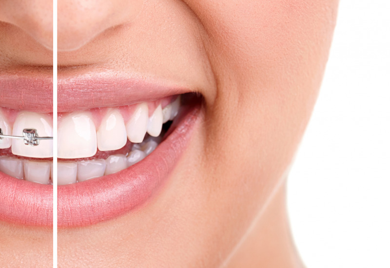 Apparecchi ortodontici mobili o invisibili per i denti: il sorriso perfetto è a portata di mano
