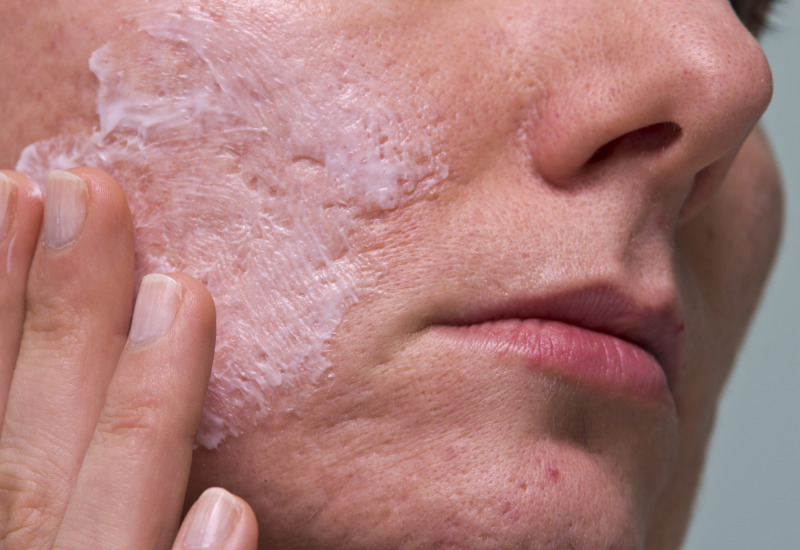 Cura cicatrici acne come contrastarle?