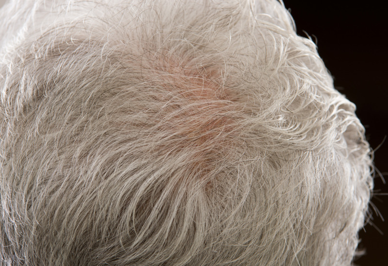Caduta dei capelli : cause e rimedi