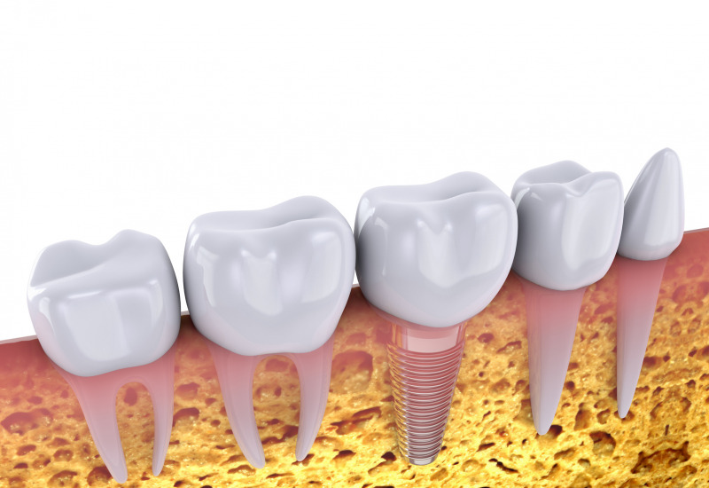 L'implantologia dentale ha sostituito la vecchia dentiera